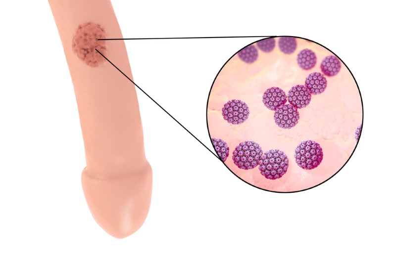 Hpv vírus keine warzen, Hpv warzen bekampfen. Papillom haut entfernen